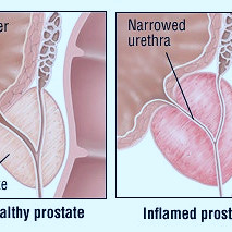 How to Manage Urinary Incontinence After a Prostatectomy